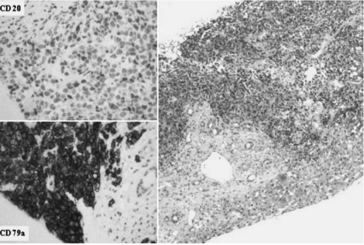 1利妥昔单抗治疗后，肝脏DLBCL（右）； CD20阳性5%，CD79a普遍阳性.png