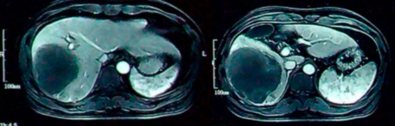 靶免治疗5个周期后腹部MRI检查影像.png