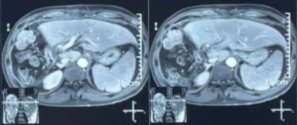 术后8个多月腹部MRI检查影像.png