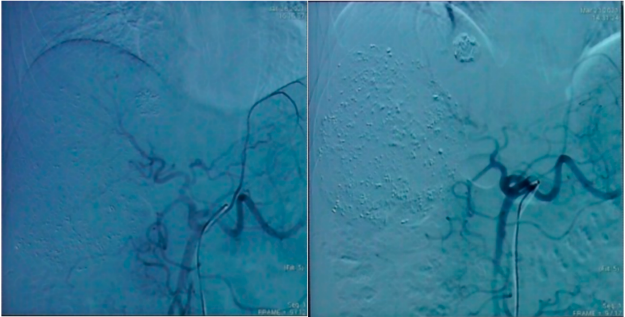 第二次（左）及第三次（右）TACE术中造影所见.png