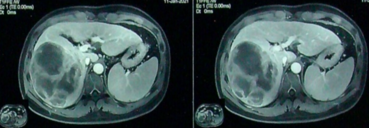 转化治疗1个周期后腹部MRI检查影像.png