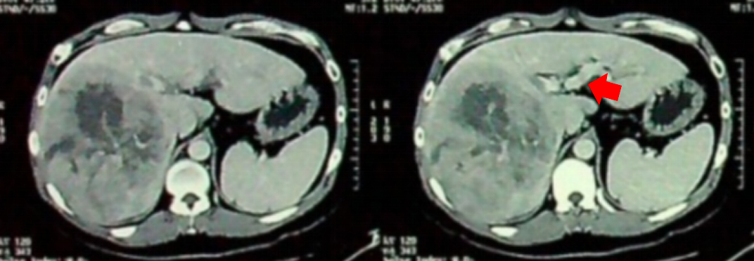 基线腹部CT影像，箭头所示为门静脉癌栓.png
