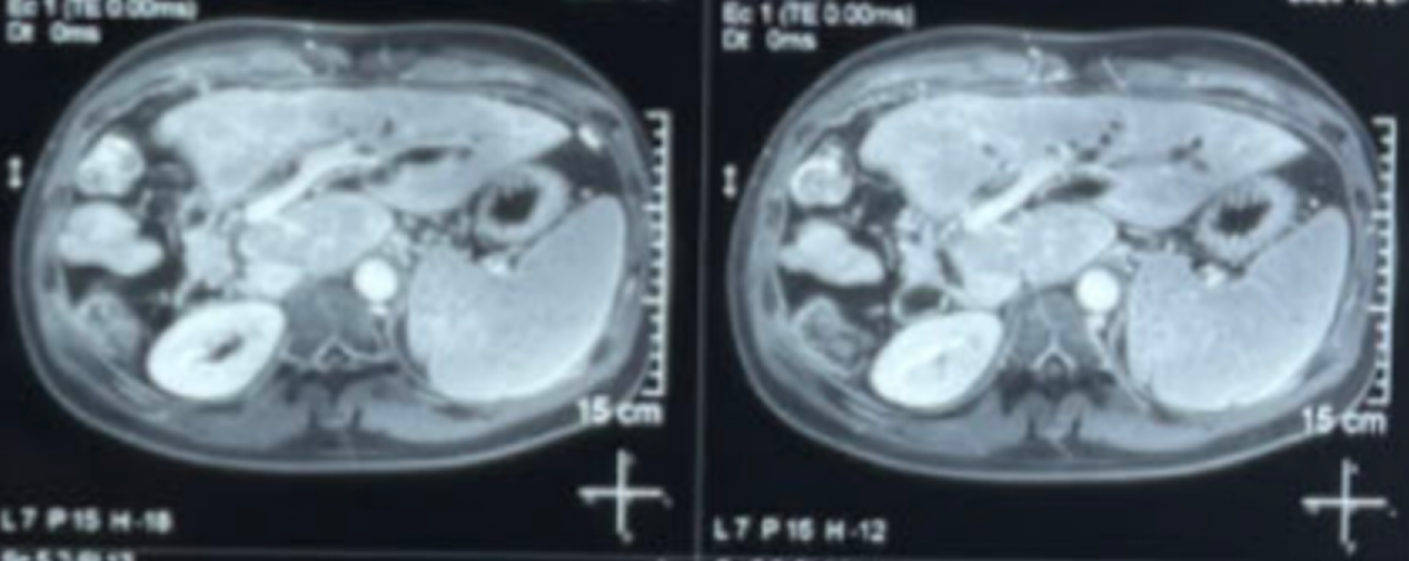 术后32个月腹部MRI检查影像.png