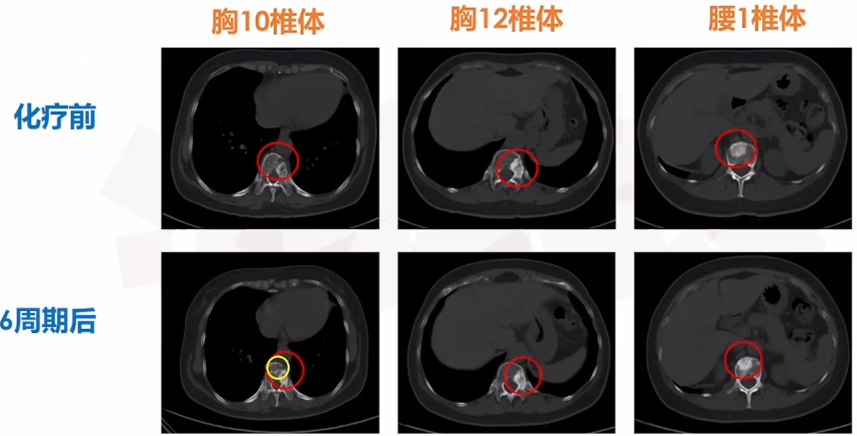 三线治疗骨转移病灶CT.png