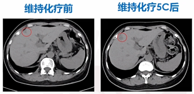 维持化疗前、后腹部CT（增强）.png