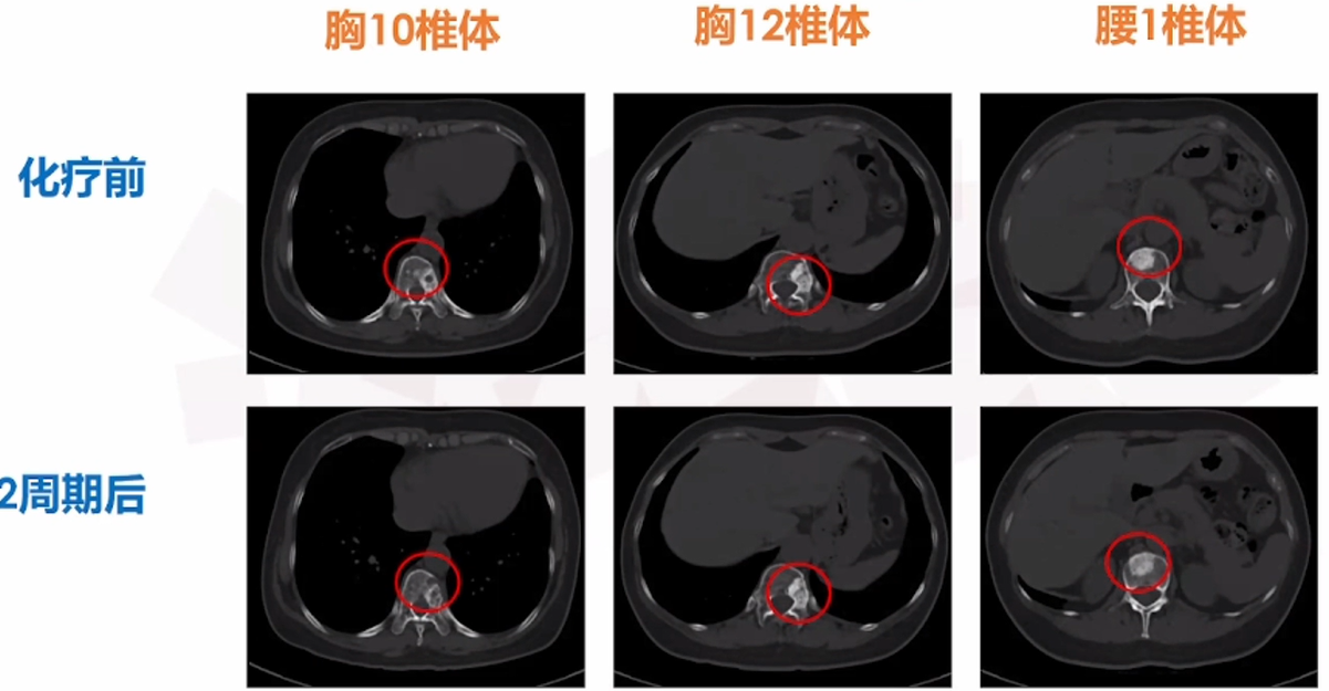 二线治疗骨转移病灶CT.png