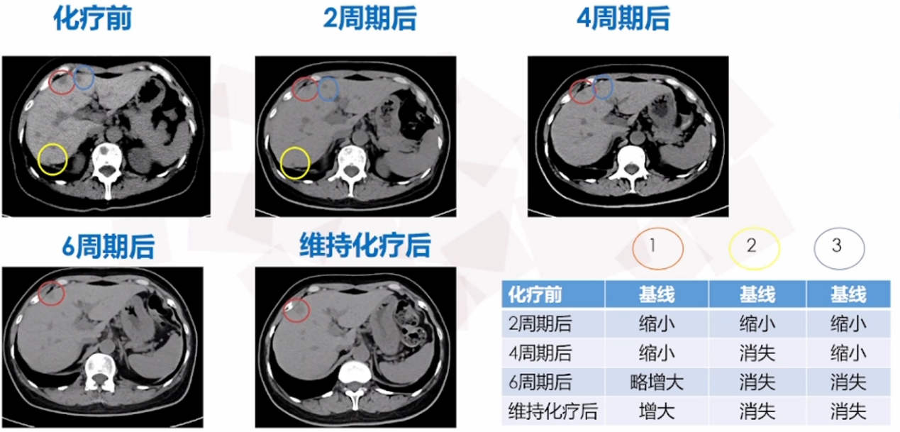 一线治疗肝转移病灶.png