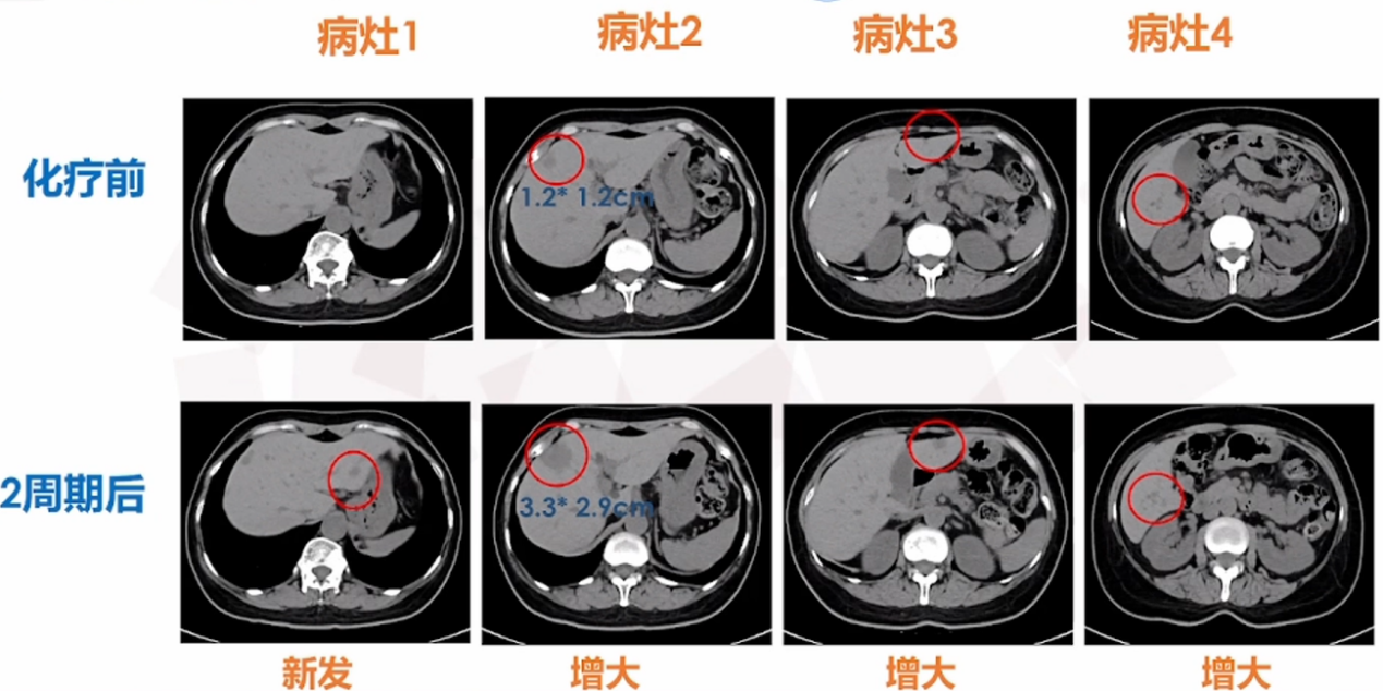 二线治疗肝转移病灶.png