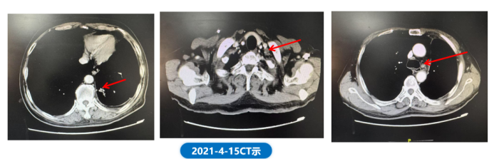 肺“长”实“例” ：从真实世界病例看EGFR ex20ins NSCLC患者综合治疗模式下的长生存漫漫路2078.png