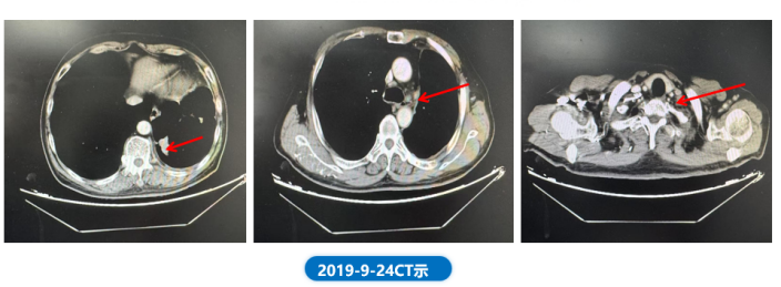 肺“长”实“例” ：从真实世界病例看EGFR ex20ins NSCLC患者综合治疗模式下的长生存漫漫路1382.png
