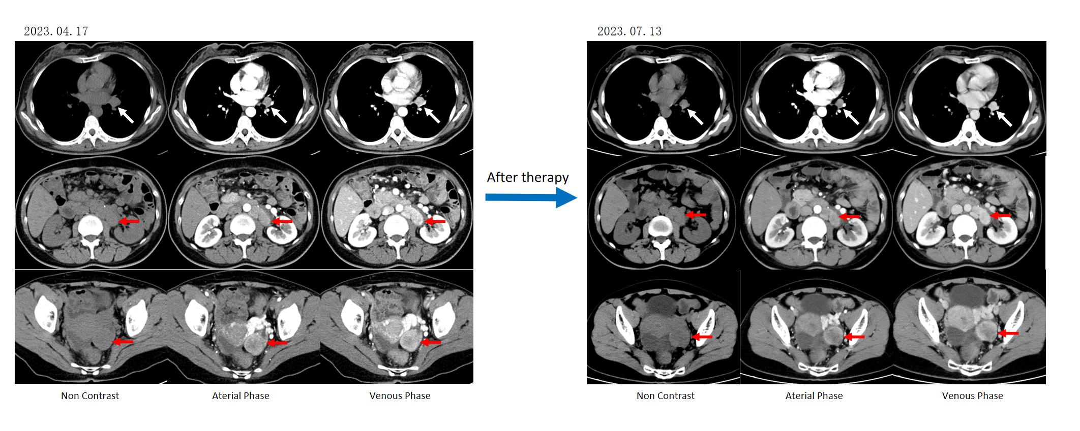 图:2023.07.17治疗后评效.png 图:2023.07.17治疗后评效.png