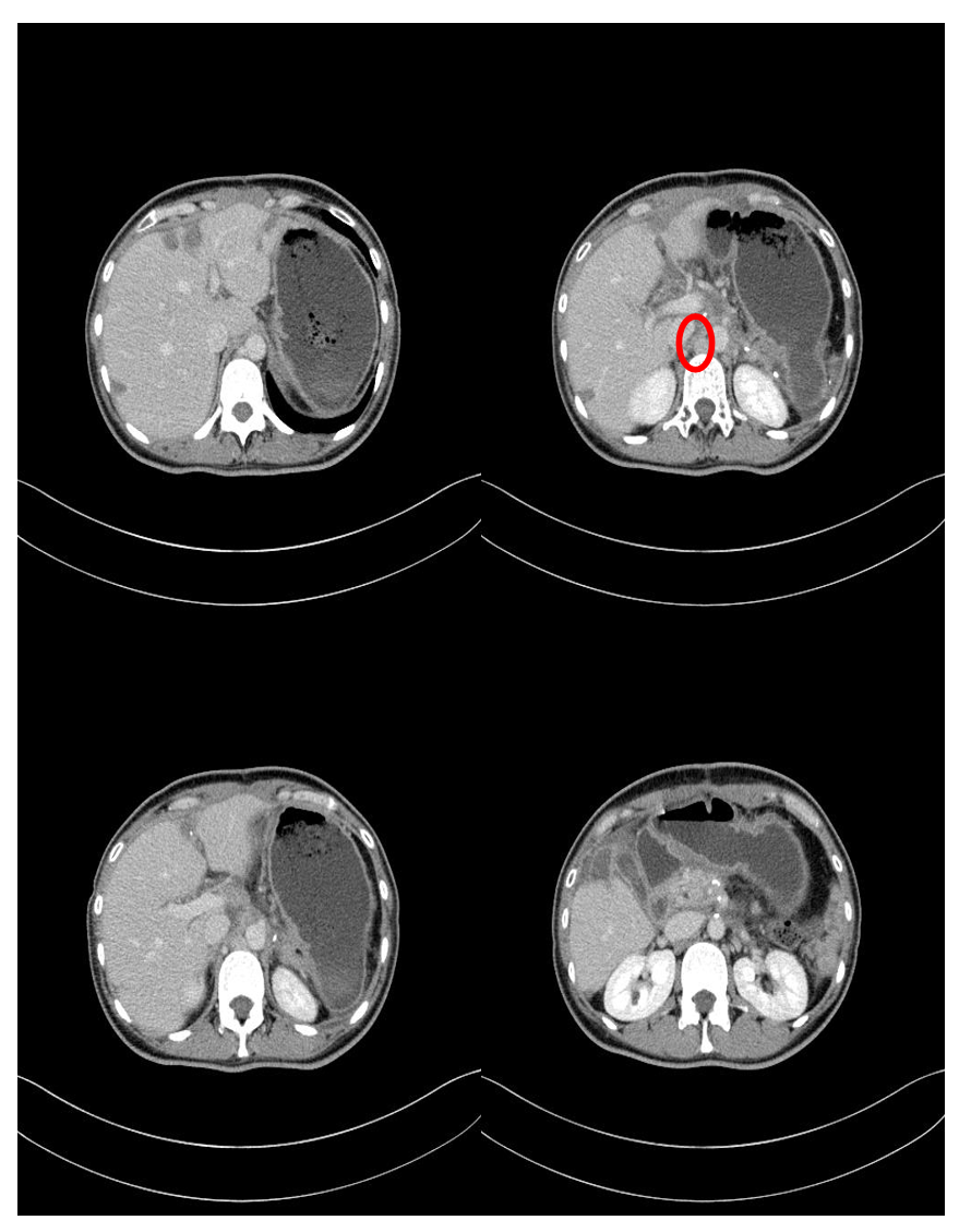 图:2019-3-5 CT增强结果.png 图:2019-3-5 CT增强结果.png