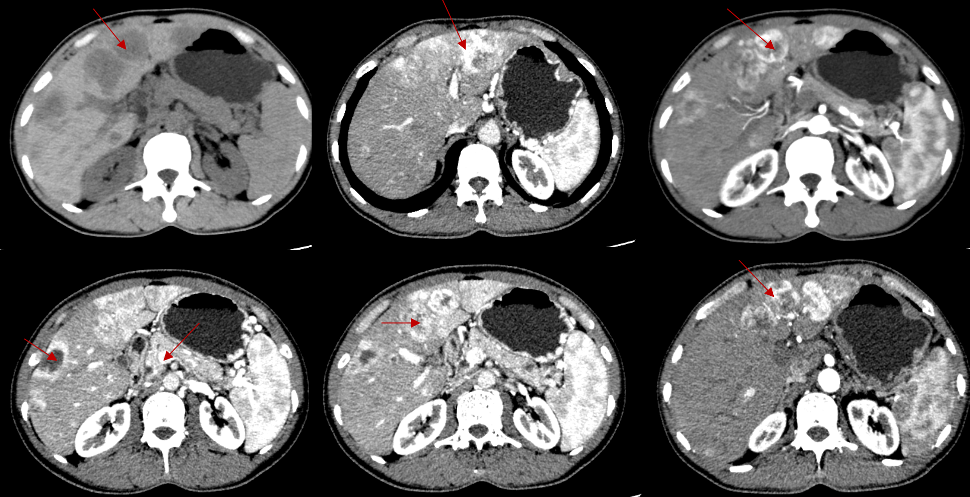 图1:1周期内分泌治疗后复查(CT).png 图1:1周期内分泌治疗后复查(CT).png