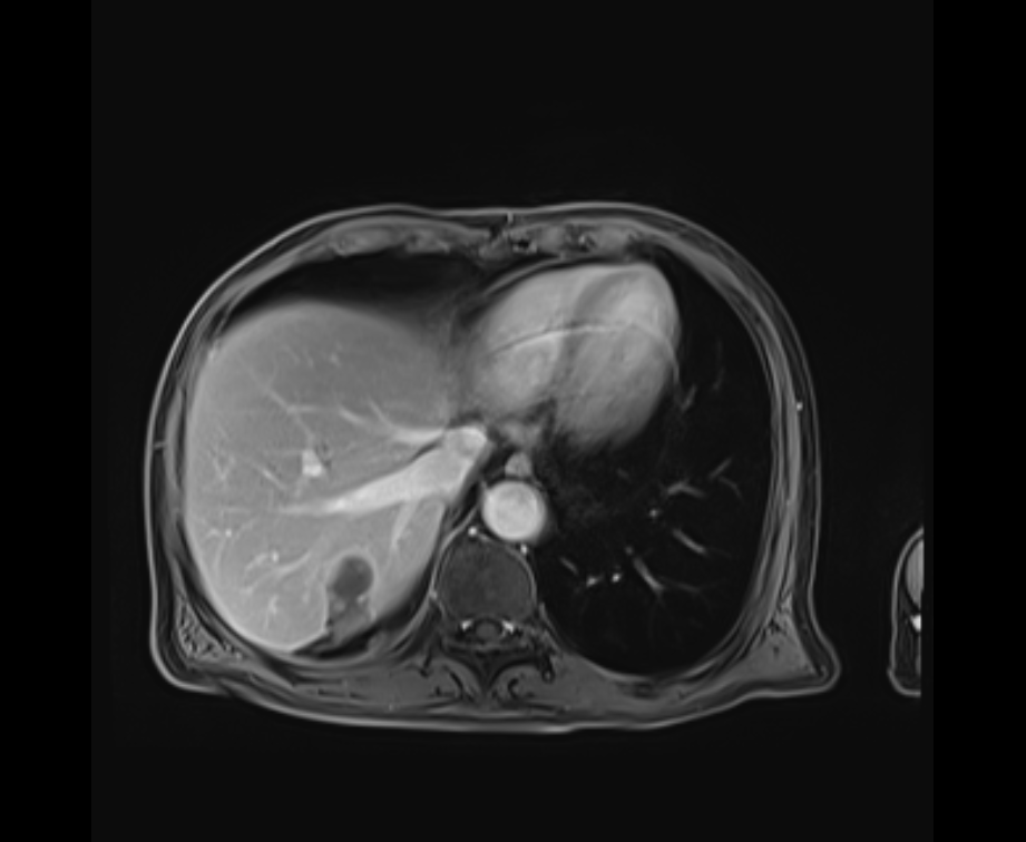微波消融术后约21个月的腹部MR影像.png
