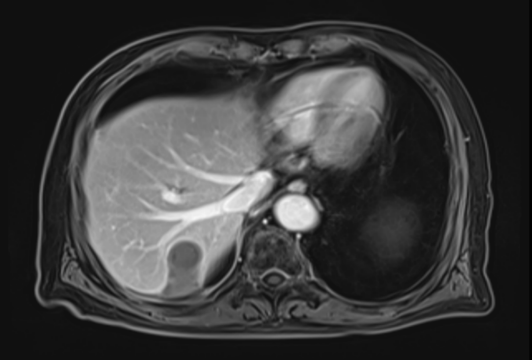 微波消融术后约3个月的腹部MR影像.png