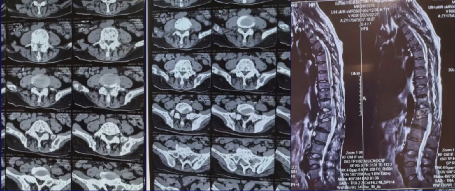 图7. 2024年2月胸腰椎MRI+三维重建.png