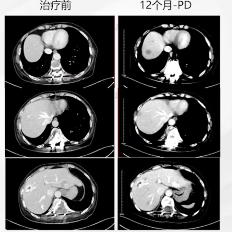 治疗12个月影像学检查.png