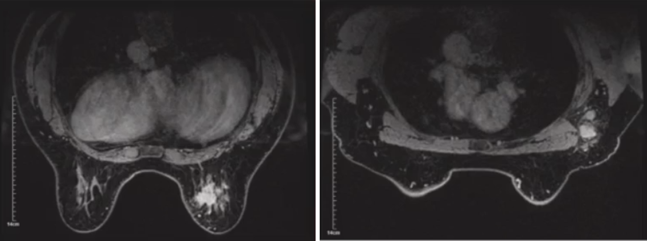 图1. 2021-8-30 乳腺增强MRI.png