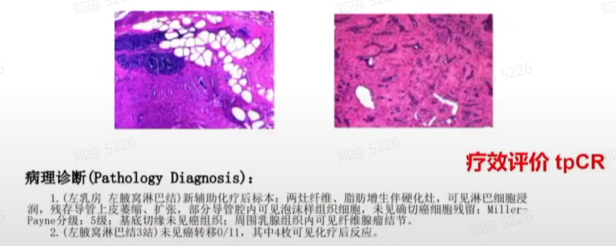 图7. 2023.11.21术后病理诊断.png