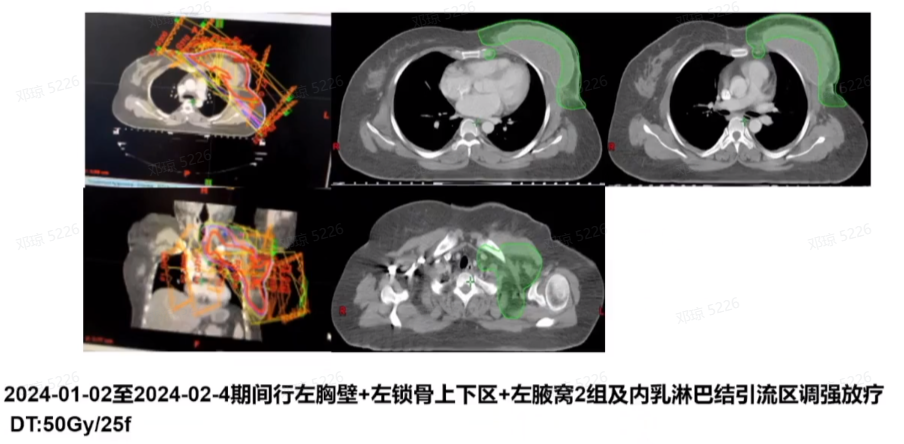 图8. 2024-01-02至2024-02-04术后放疗.png