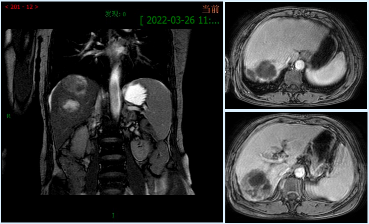 新辅助治疗后腹部MRI影像.png