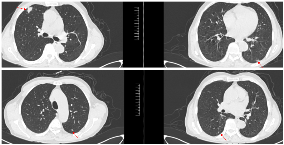 图3. 胸部CT检查(2024年7月19日).png 图3. 胸部CT检查(2024年7月19日).png