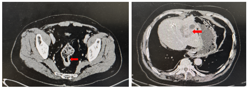 图1. 腹部CT检查(2024年6月).png 图1. 腹部CT检查(2024年6月).png