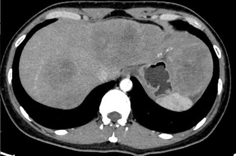 图2. 腹部CT检查.png 图2. 腹部CT检查.png