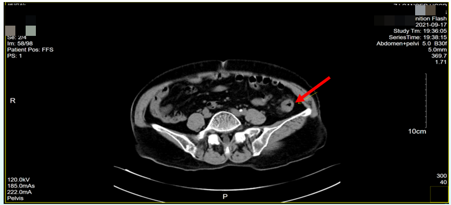 图2. 盆腔CT检查(2021年9月17日).png 图2. 盆腔CT检查(2021年9月17日).png