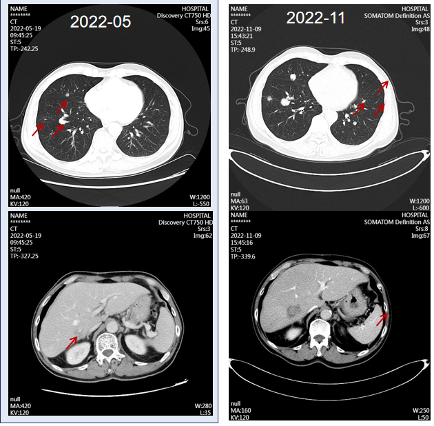 图4.胸腹部CT(左:2022年5月;右:2022年11月).png 图4.胸腹部CT(左:2022年5月;右:2022年11月).png