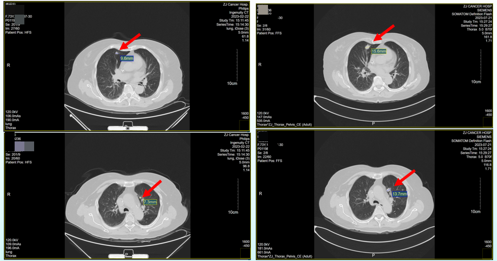 图3. 胸部CT检查(左:2023年2月22日;右:2023年7月21日).png 图3. 胸部CT检查(左:2023年2月22日;右:2023年7月21日).png