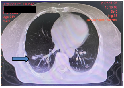 图1. 胸部CT检查(2022年11月22日).png 图1. 胸部CT检查(2022年11月22日).png